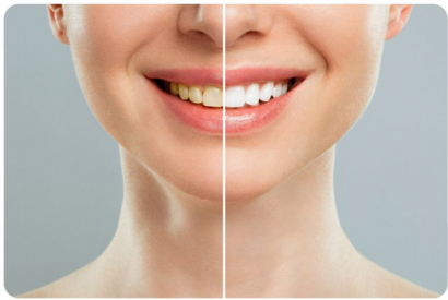 La cigarette &eacute;lectronique jaunit-elle les dents ?